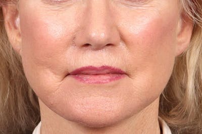 Lip Lift Before & After Gallery - Patient 287016 - Image 2