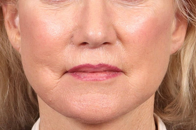 Lip Lift Before & After Gallery - Patient 287016 - Image 2