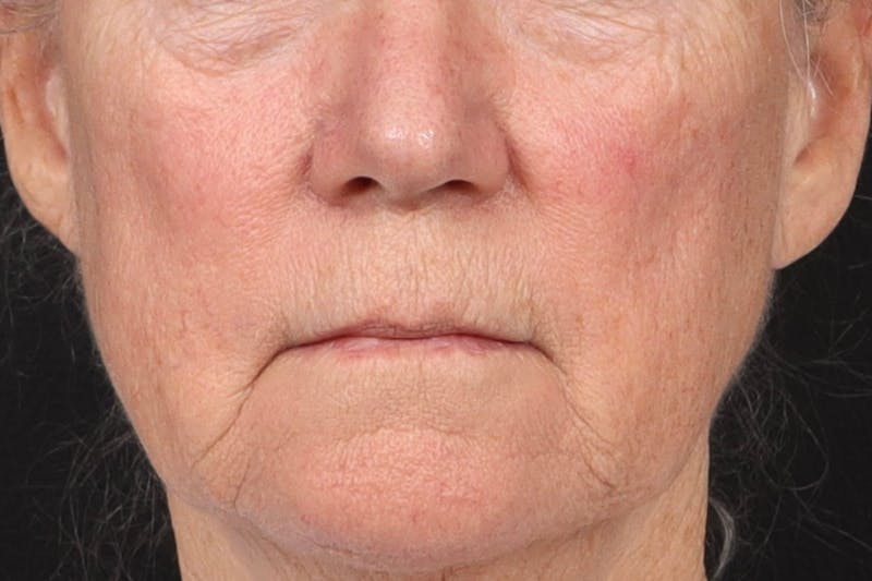 Lip Lift Before & After Gallery - Patient 287016 - Image 1