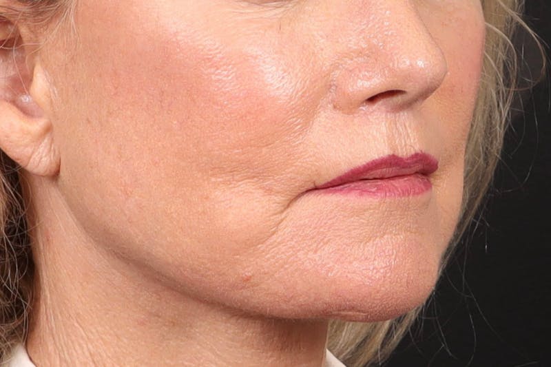Lip Lift Before & After Gallery - Patient 287016 - Image 4