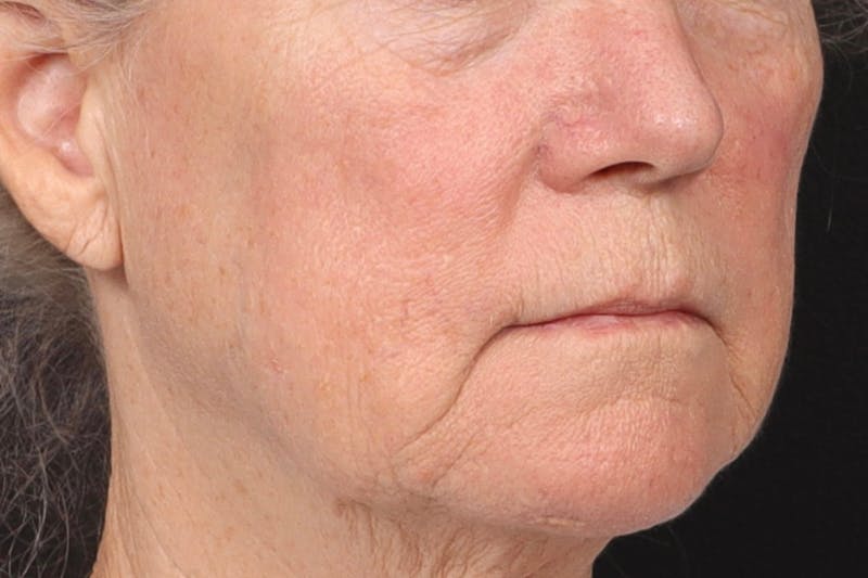 Lip Lift Before & After Gallery - Patient 287016 - Image 3