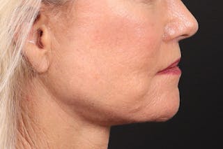 Lip Lift Before & After Gallery - Patient 287016 - Image 6