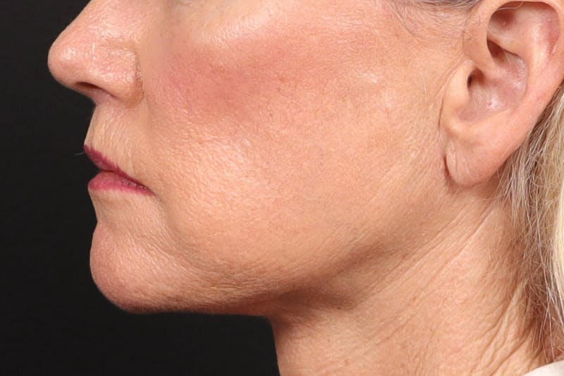 Lip Lift Before & After Gallery - Patient 287016 - Image 8
