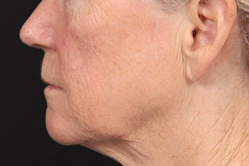 Lip Lift Before & After Gallery - Patient 287016 - Image 7