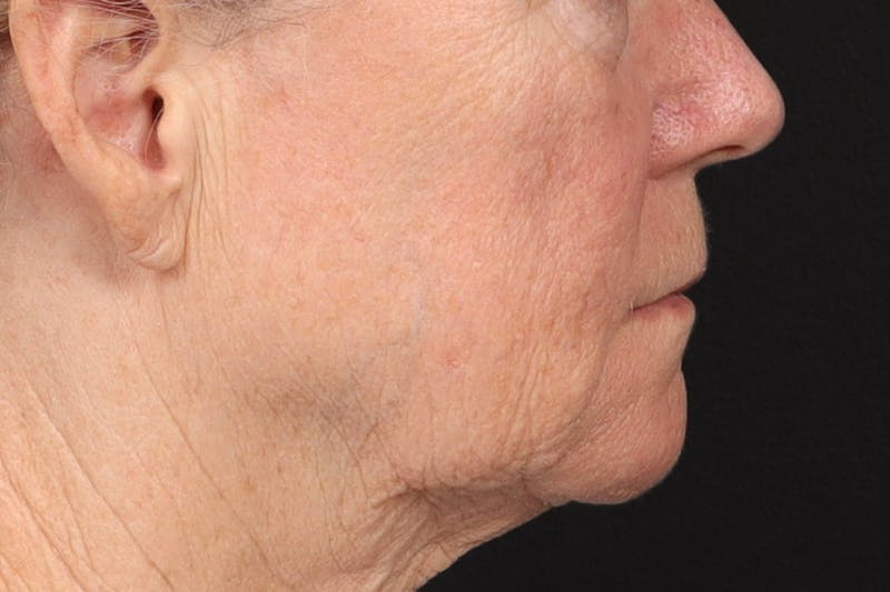 Lip Lift Before & After Gallery - Patient 287016 - Image 5