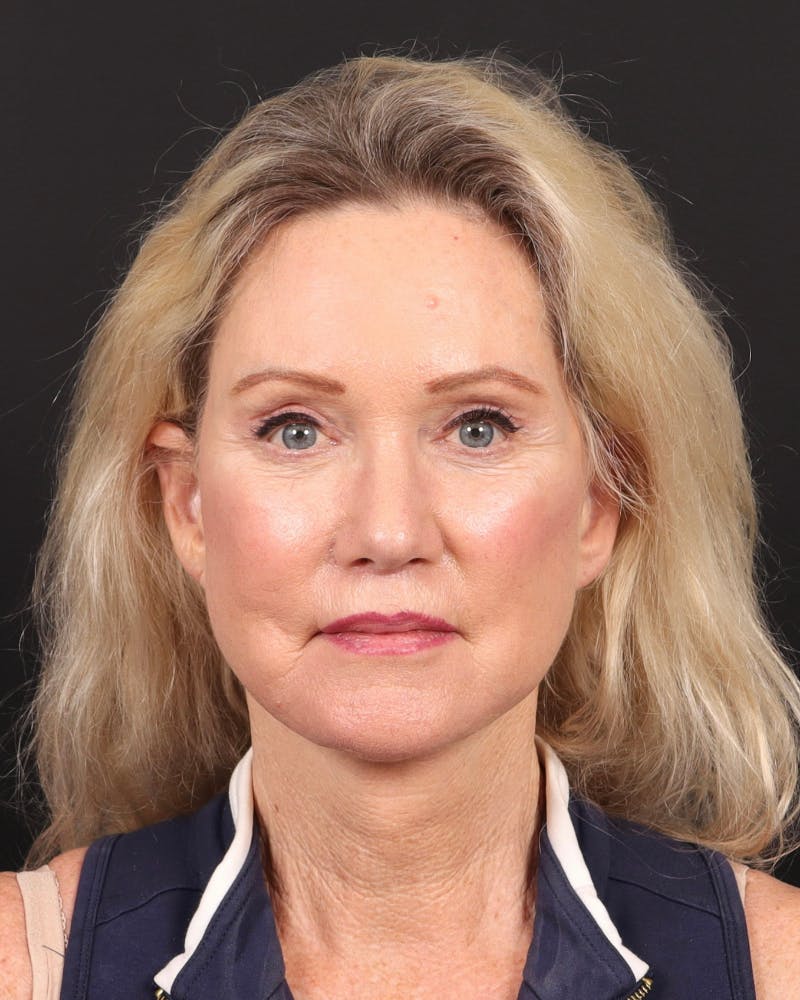 Neck Lift Before & After Gallery - Patient 364159 - Image 2