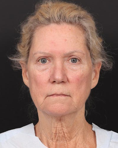 Facelift Before & After Gallery - Patient 853008 - Image 1