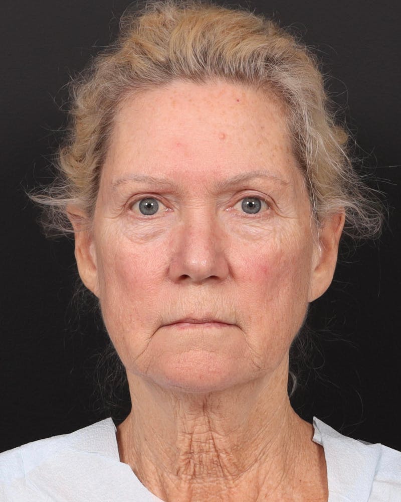 Neck Lift Before & After Gallery - Patient 364159 - Image 1