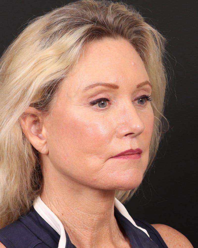 Neck Lift Before & After Gallery - Patient 364159 - Image 4