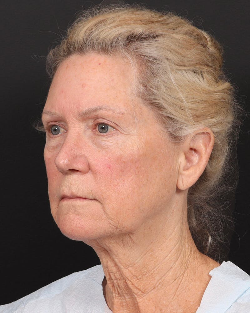 Neck Lift Before & After Gallery - Patient 364159 - Image 9