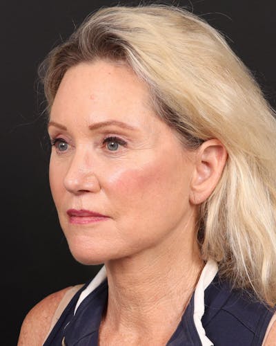 Neck Lift Before & After Gallery - Patient 364159 - Image 2