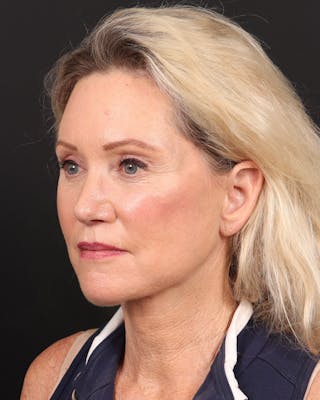 Neck Lift Before & After Gallery - Patient 364159 - Image 10