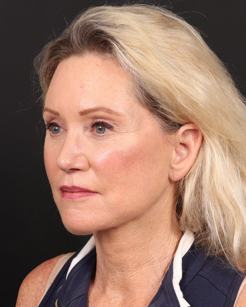 Neck Lift Before & After Gallery - Patient 364159 - Image 10