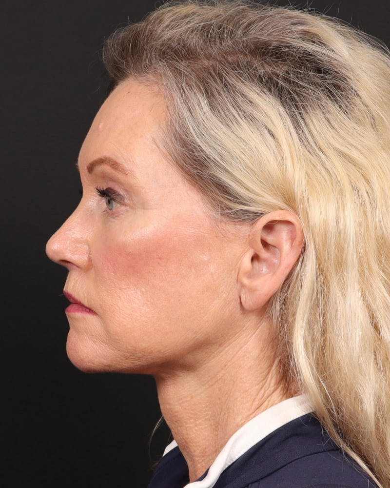Neck Lift Before & After Gallery - Patient 364159 - Image 8