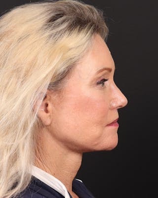 Neck Lift Before & After Gallery - Patient 364159 - Image 6