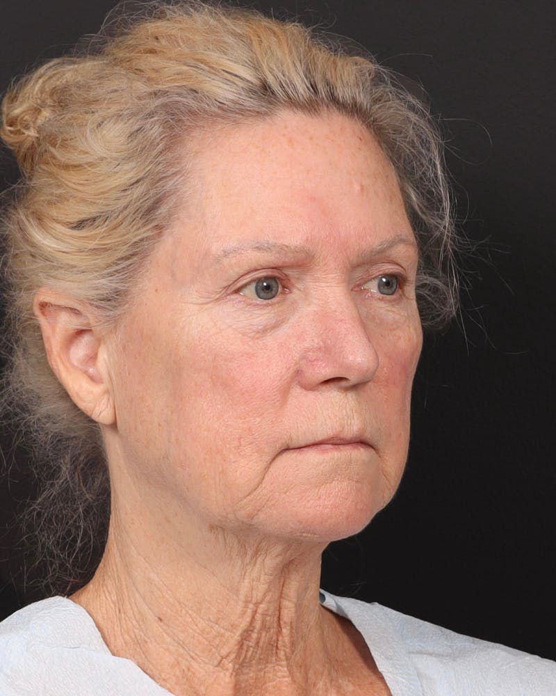 Neck Lift Before & After Gallery - Patient 364159 - Image 3