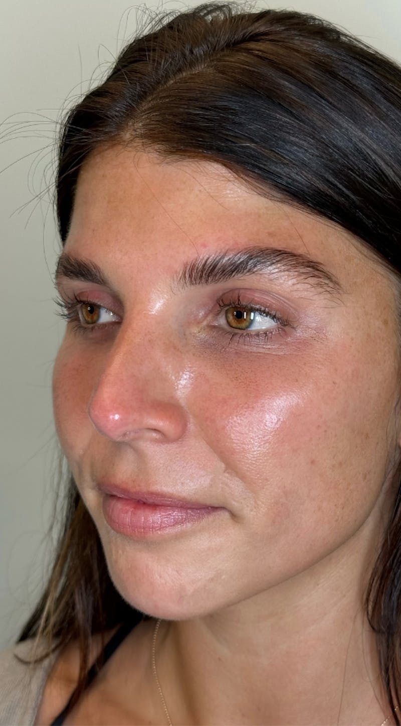 Facial Balancing Before & After Gallery - Patient 183401 - Image 1