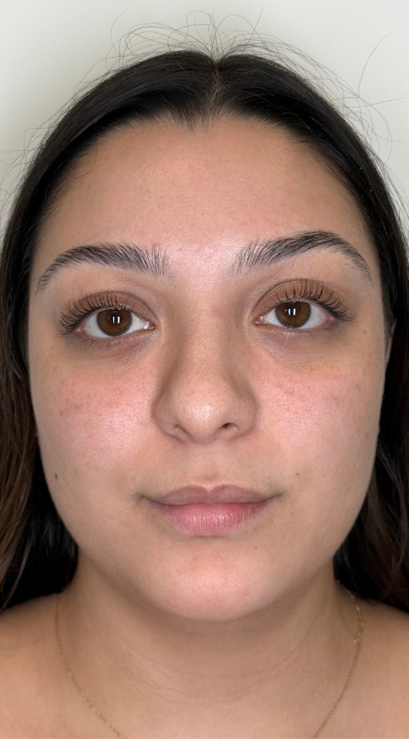 Facial Balancing Before & After Gallery - Patient 146721 - Image 3