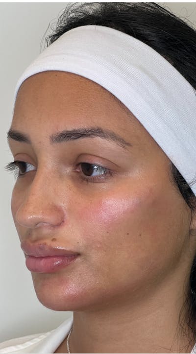 Facial Balancing Before & After Gallery - Patient 181826118 - Image 2