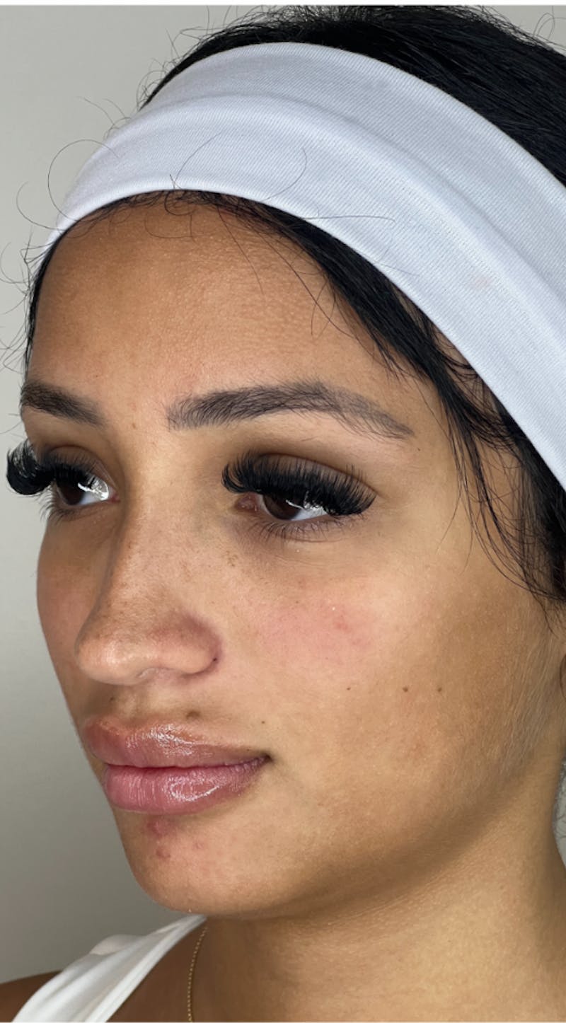 Facial Balancing Before & After Gallery - Patient 181826118 - Image 1