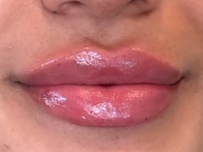 Lip Filler Before & After Gallery - Patient 310969 - Image 2