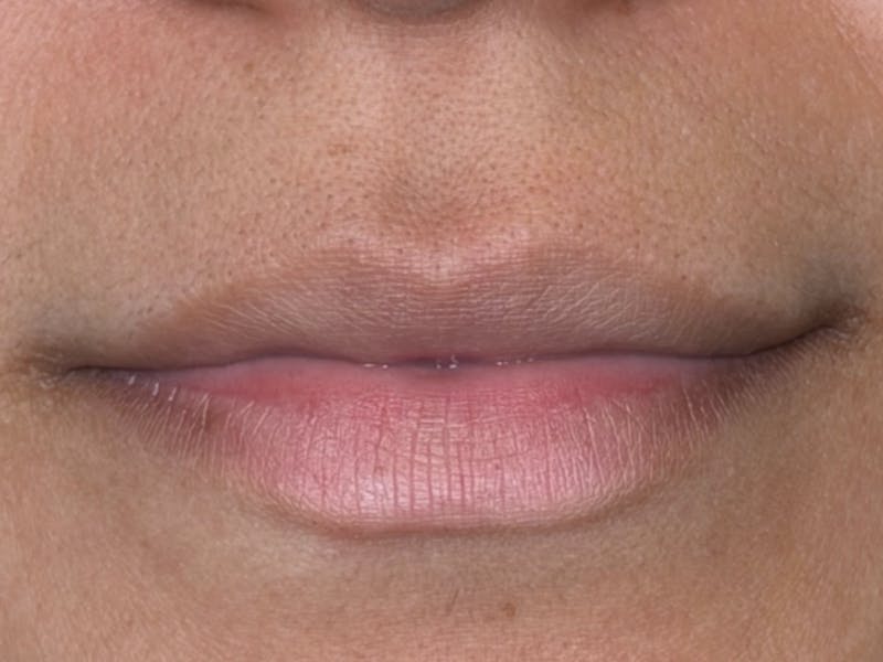 Lip Filler Before & After Gallery - Patient 310969 - Image 1
