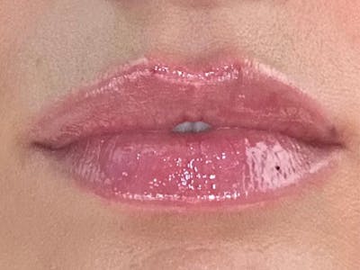 Lip Filler Before & After Gallery - Patient 132145 - Image 2