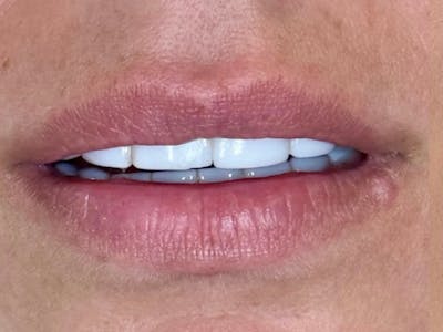 Lip Filler Before & After Gallery - Patient 132145 - Image 1