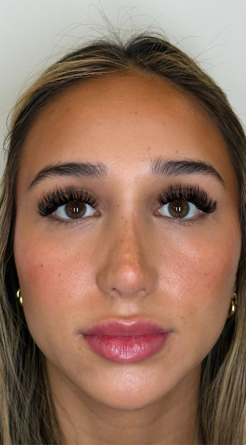 Facial Balancing Before & After Gallery - Patient 173233 - Image 2