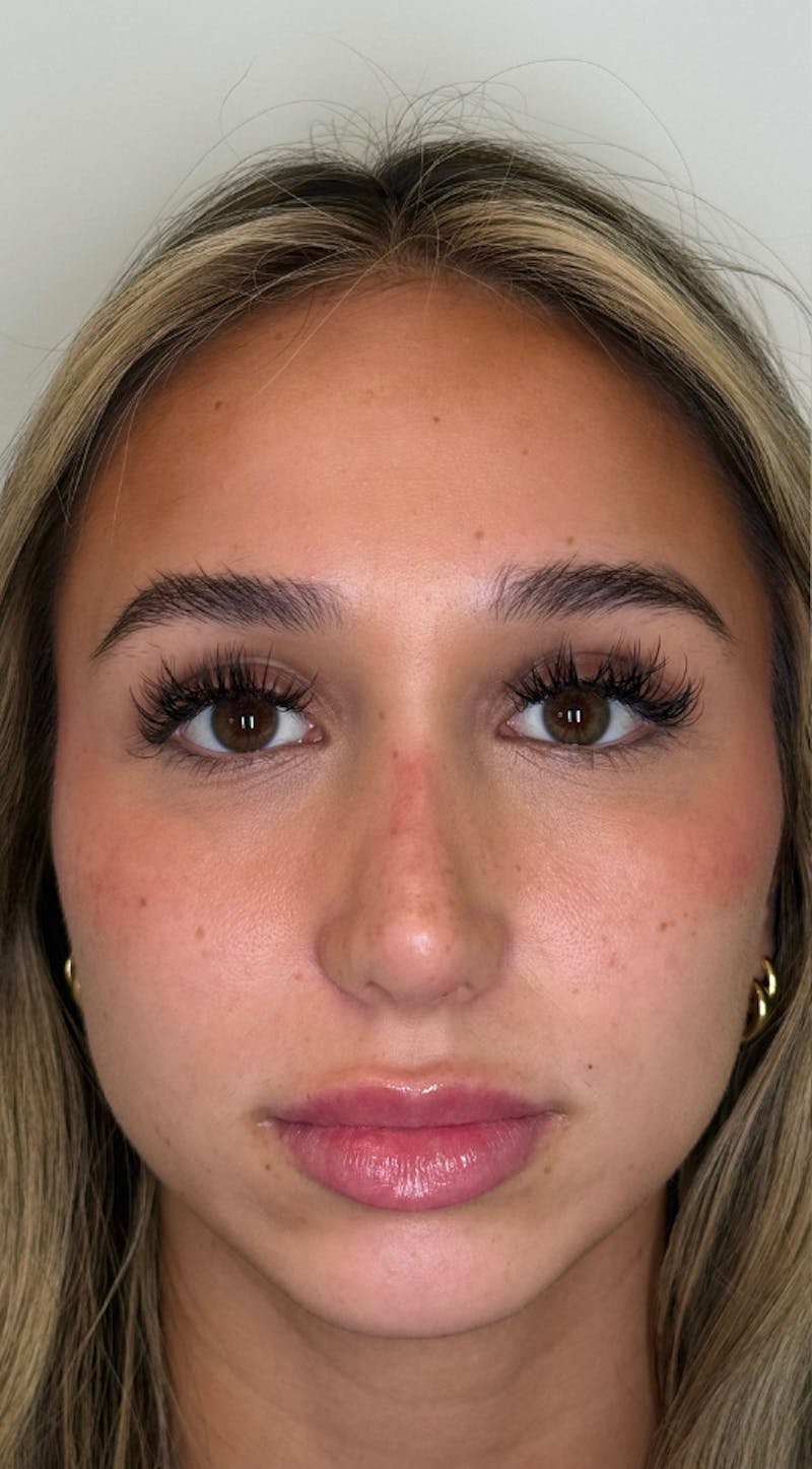 Facial Balancing Before & After Gallery - Patient 173233 - Image 1