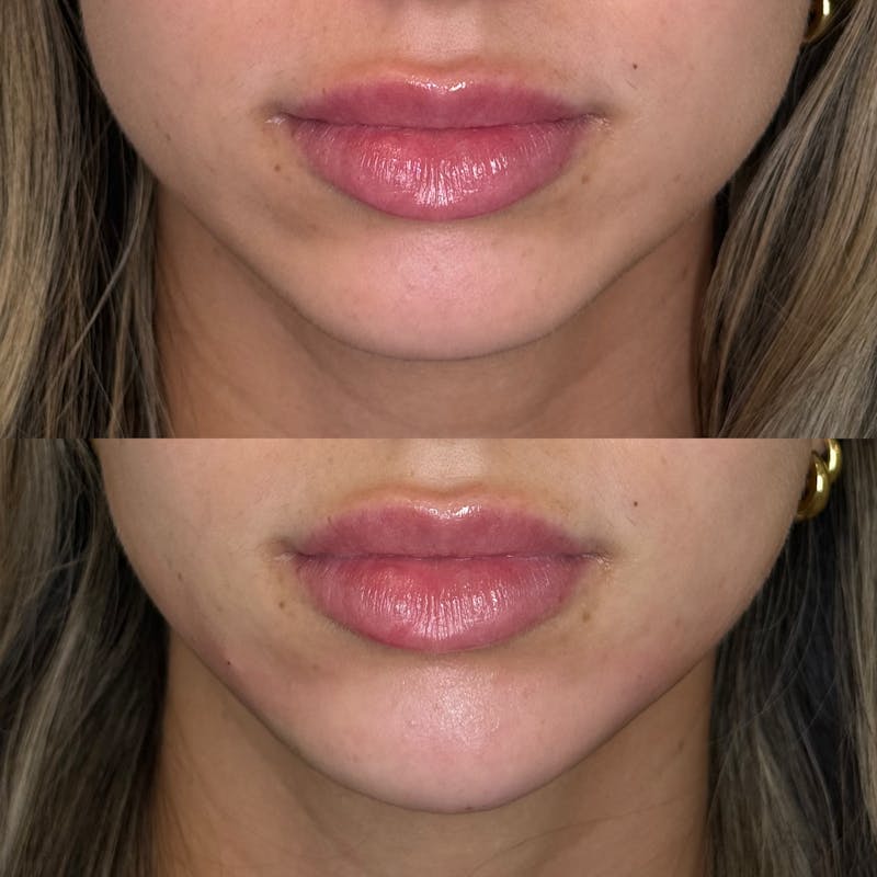 Facial Balancing Before & After Gallery - Patient 173233 - Image 3