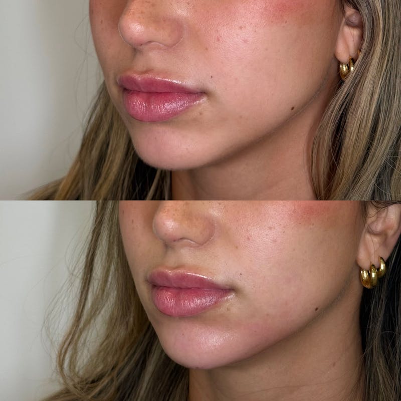 Facial Balancing Before & After Gallery - Patient 173233 - Image 4