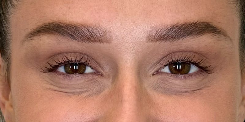 Dysport Before & After Gallery - Patient 263403 - Image 4