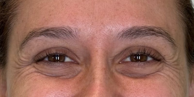 Dysport Before & After Gallery - Patient 263403 - Image 3