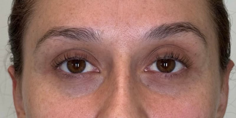 Dysport Before & After Gallery - Patient 263403 - Image 7