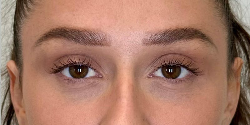 Dysport Before & After Gallery - Patient 263403 - Image 8