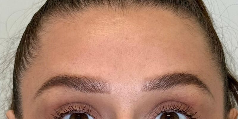 Dysport Before & After Gallery - Patient 263403 - Image 2