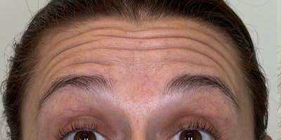 Dysport Before & After Gallery - Patient 263403 - Image 1