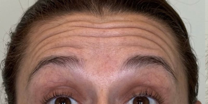 Dysport Before & After Gallery - Patient 263403 - Image 1