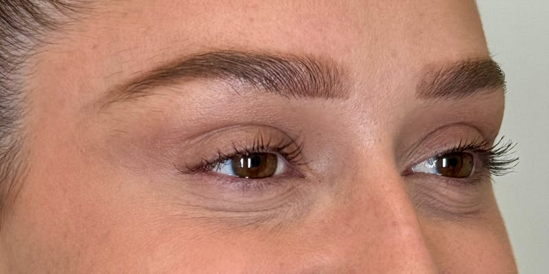 Dysport Before & After Gallery - Patient 263403 - Image 6