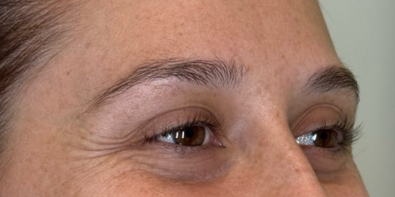 Dysport Before & After Gallery - Patient 263403 - Image 5