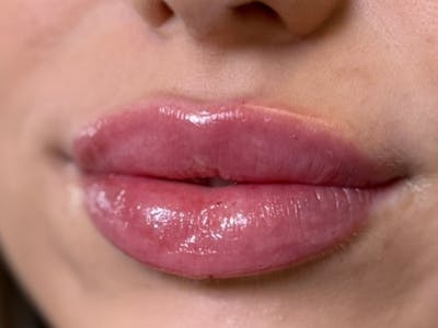 Lip Filler Before & After Gallery - Patient 347207 - Image 2
