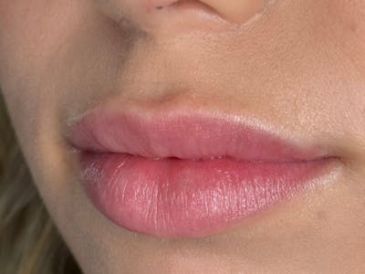 Lip Filler Before & After Gallery - Patient 347207 - Image 1