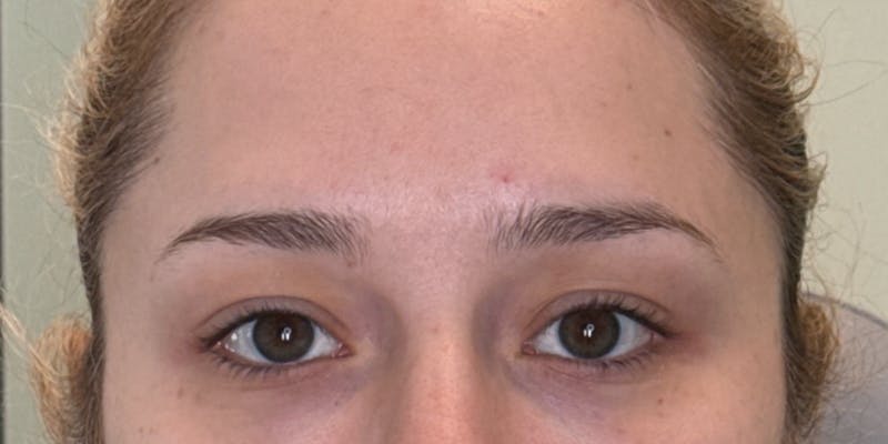 Dysport Before & After Gallery - Patient 207478 - Image 4