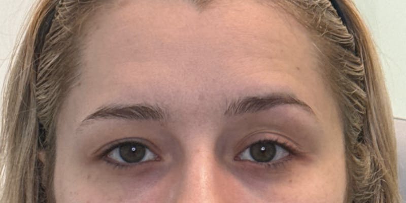 Dysport Before & After Gallery - Patient 207478 - Image 3