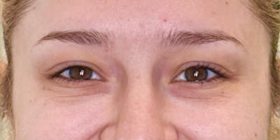 Dysport Before & After Gallery - Patient 207478 - Image 2