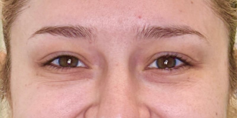 Dysport Before & After Gallery - Patient 207478 - Image 2