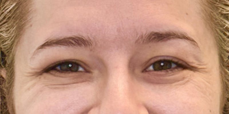 Dysport Before & After Gallery - Patient 207478 - Image 1