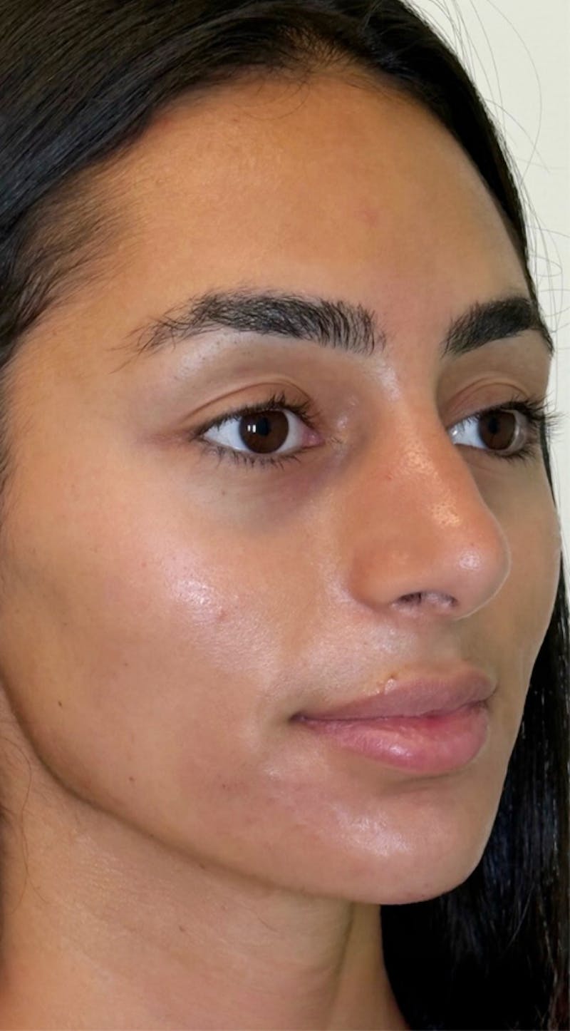 Facial Balancing Before & After Gallery - Patient 159405 - Image 2