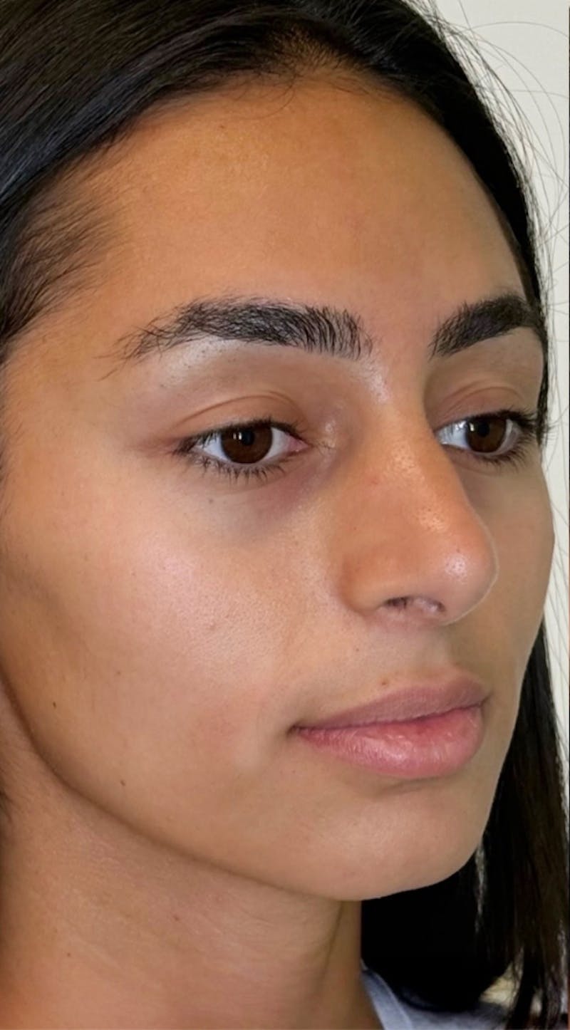 Facial Balancing Before & After Gallery - Patient 159405 - Image 1